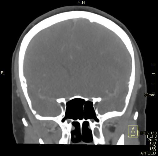 Cerebral venous sinus thrombosis (Radiopaedia 91329-108965 Coronal venogram 33).jpg