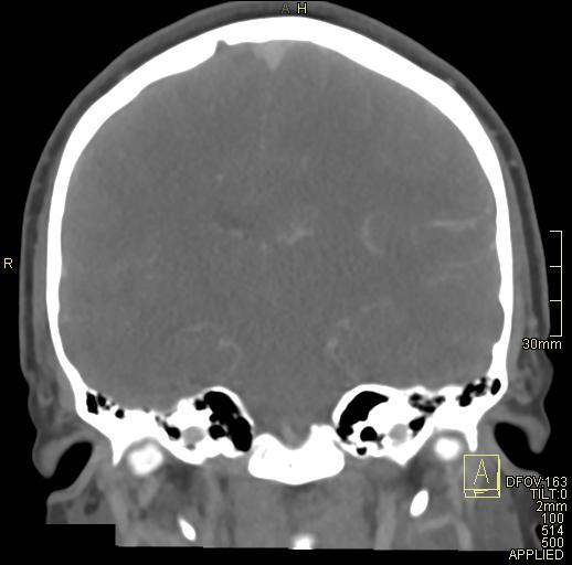Cerebral venous sinus thrombosis (Radiopaedia 91329-108965 Coronal venogram 49).jpg