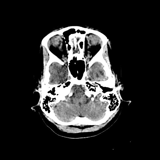 Cerebral venous throbmosis - hemorrhagic venous infarction (Radiopaedia 87318-103613 Axial non-contrast 32).jpg