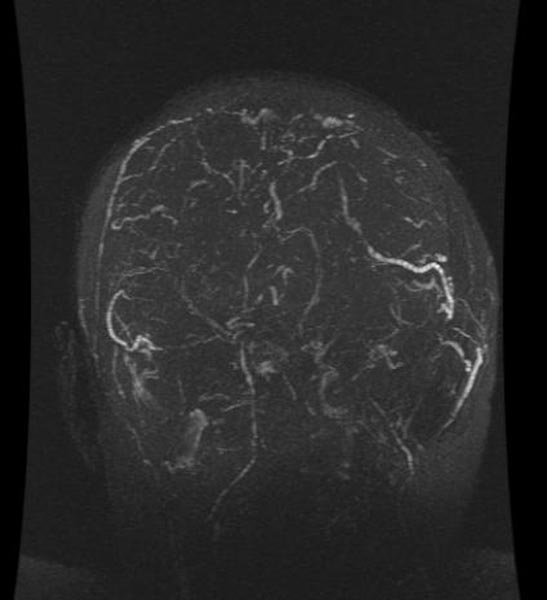 File:Cerebral venous thrombosis (Radiopaedia 11289-11653 None 2).jpg