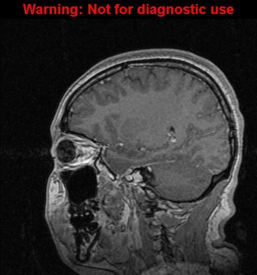 Cerebral venous thrombosis (Radiopaedia 37224-39208 Sagittal T1 C+ 101).jpg