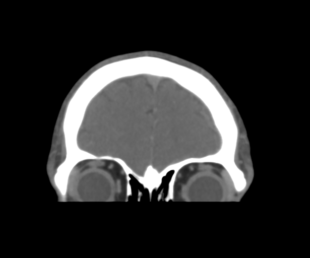 Cerebral venous thrombosis (Radiopaedia 38392-40467 Coronal CTA-Venogram 11).png
