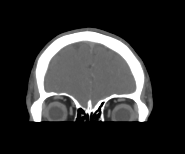 Cerebral venous thrombosis (Radiopaedia 38392-40467 Coronal CTA-Venogram 12).png
