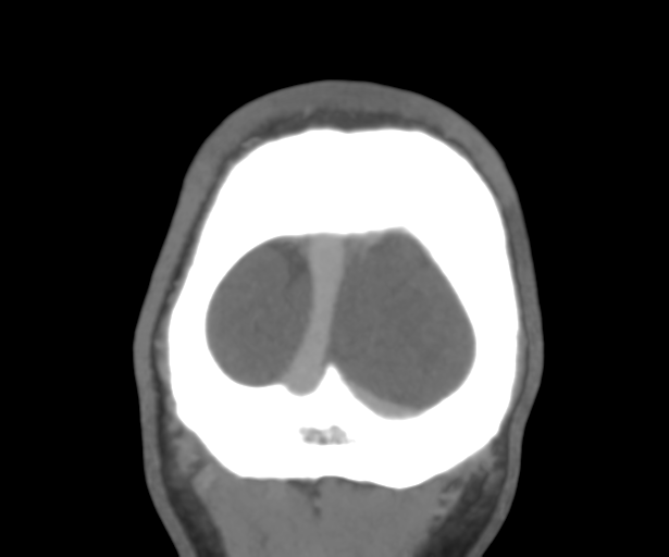 Cerebral venous thrombosis (Radiopaedia 38392-40467 Coronal CTA-Venogram 58).png