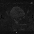Cervical adenocarcinoma (Radiopaedia 65011-73985 Axial DWI 36).jpg