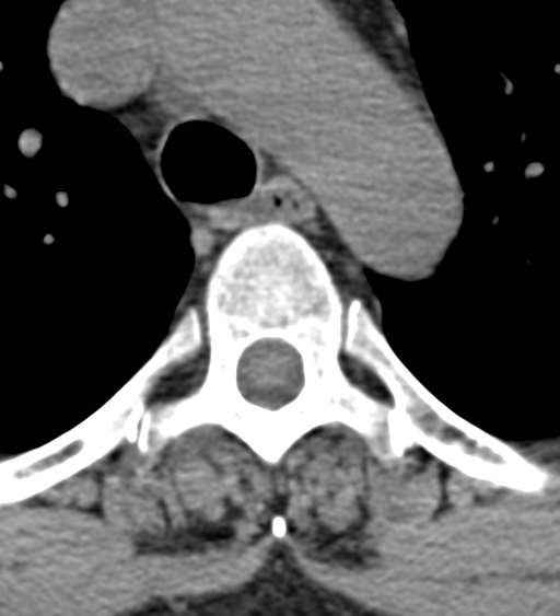 Cervical canal stenosis due to ossification of the posterior longitudinal ligament (Radiopaedia 47260-51823 Axial non-contrast 75).png