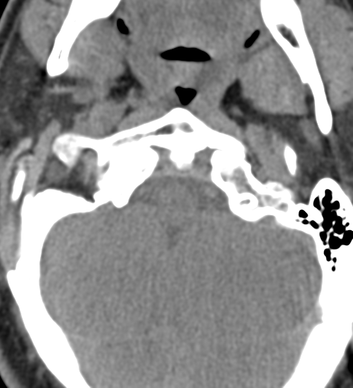 Cervical canal stenosis due to ossification of the posterior longitudinal ligament (Radiopaedia 47260-51823 Axial non-contrast 9).png
