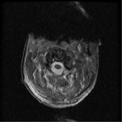 Cervical canal stenosis with cord compression (Radiopaedia 34114-35374 Axial Gradient Echo 88).png
