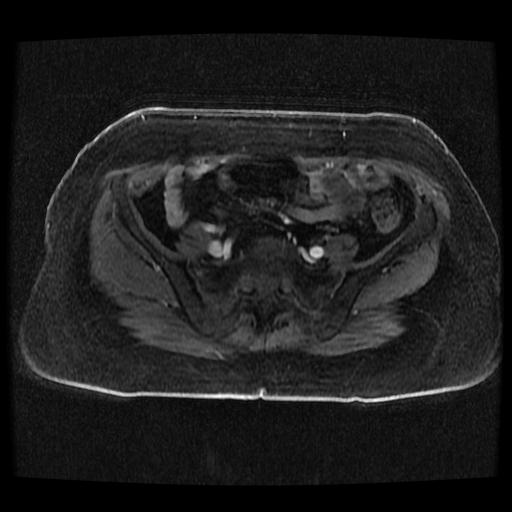 Cervical carcinoma (Radiopaedia 70924-81132 Axial T1 C+ fat sat 73).jpg