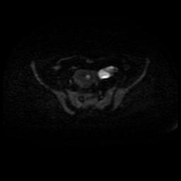 Cervical carcinoma (Radiopaedia 88010-104555 Axial DWI 38).jpg