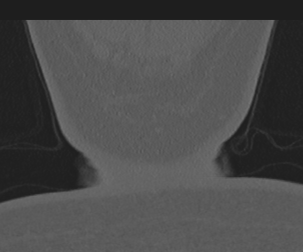 Cervical disc replacement (Radiopaedia 44025-47541 Coronal bone window 63).png