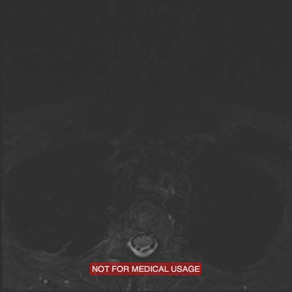 Cervical nerve schwannoma (Radiopaedia 27964-28221 C 51).jpg
