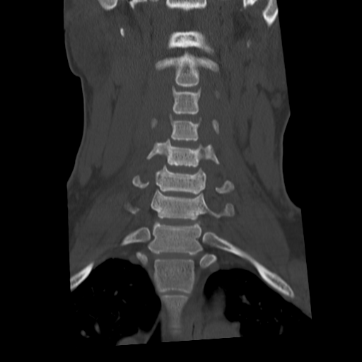 Cervical schwannoma (Radiopaedia 57979-64974 Coronal bone window 25).png