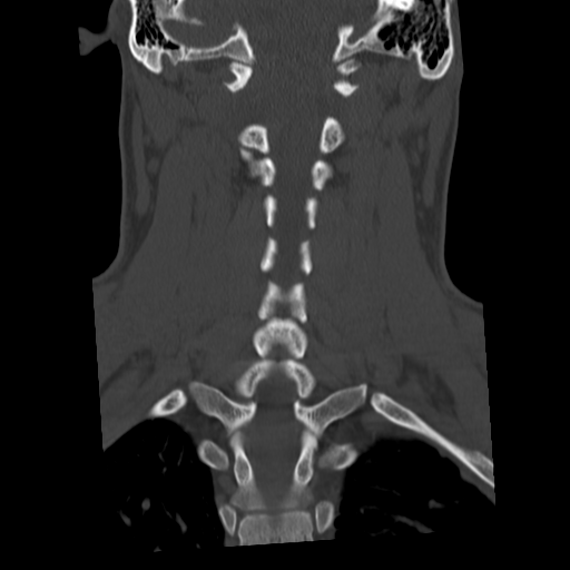 Cervical schwannoma (Radiopaedia 57979-64974 Coronal bone window 36).png