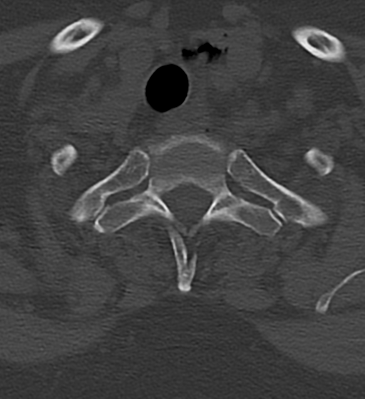 Cervical spine ACDF loosening (Radiopaedia 48998-54070 Axial bone window 54).png