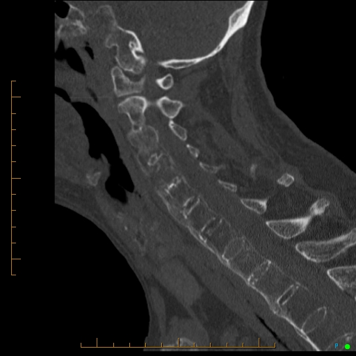 Cervical spine fracture - ankylosing spondylitis (Radiopaedia 76835-88706 Sagittal bone window 49).jpg