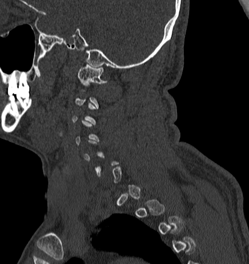 Cervical spine trauma with tear drop fracture and perched facet joint (Radiopaedia 53989-60127 Sagittal bone window 142).jpg