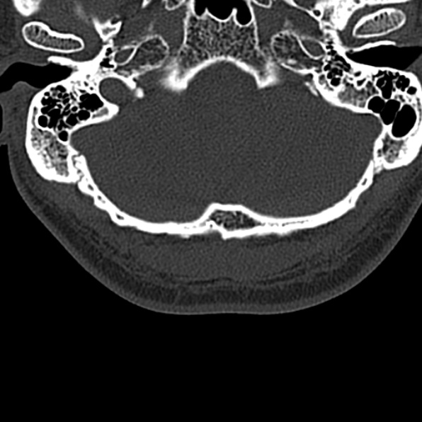 Cervical spondylodiscitis (Radiopaedia 28057-29489 Axial bone window 7).jpg