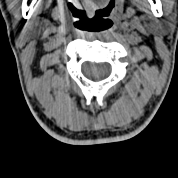 Cervical spondylodiscitis (Radiopaedia 28057-29489 Axial non-contrast 25).jpg