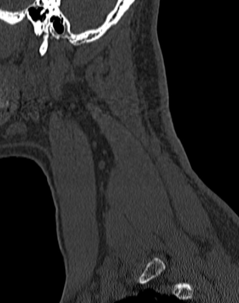 Cervical spondylodiscitis (Radiopaedia 28057-29489 Sagittal bone window 11).jpg