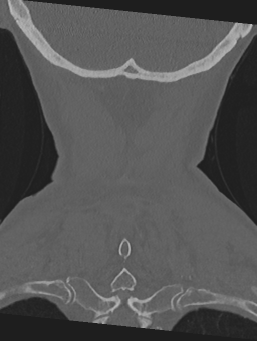 Cervical spondylolysis (Radiopaedia 49616-54811 Coronal bone window 55).png