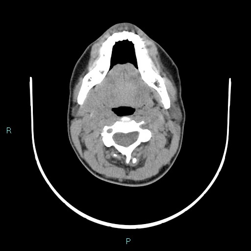 File:Cervical thymic cyst (Radiopaedia 88632-105335 Axial non-contrast 80).jpg