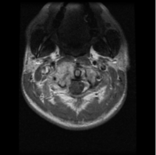File:Cervical vertebrae metastasis (Radiopaedia 78814-91667 Axial T1 C+ 24).png