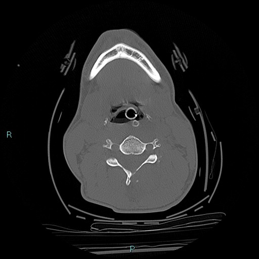 File:Cervical vertebral burst fracture (Radiopaedia 37420-39258 Axial bone window 44).jpg