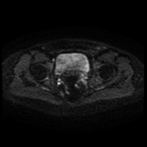 Cesarian section scar endometriosis (Radiopaedia 66520-75799 Axial DWI 43).jpg