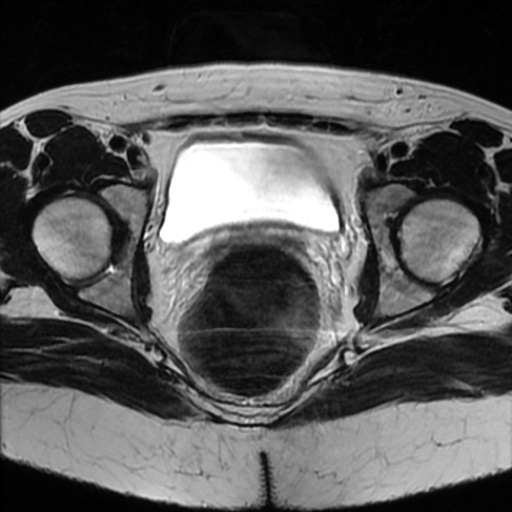 File:Cesarian section scar endometriosis (Radiopaedia 66520-75799 Axial T2 17).jpg