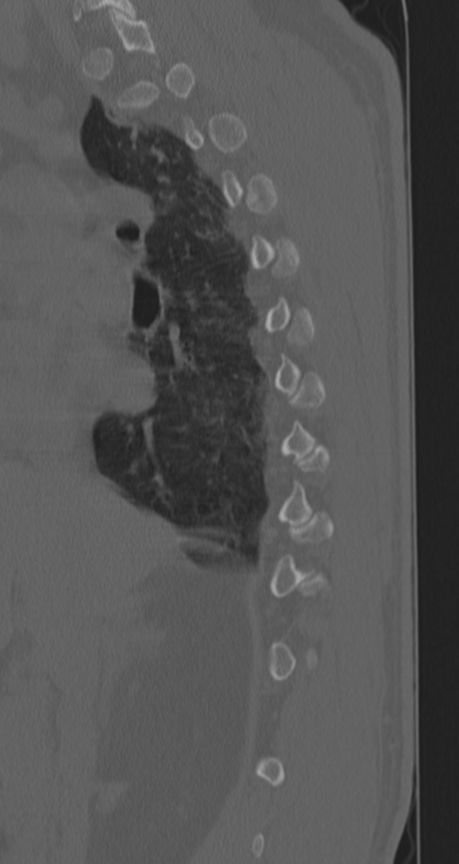 Chance fracture (Radiopaedia 33854-35020 Sagittal bone window 62).png