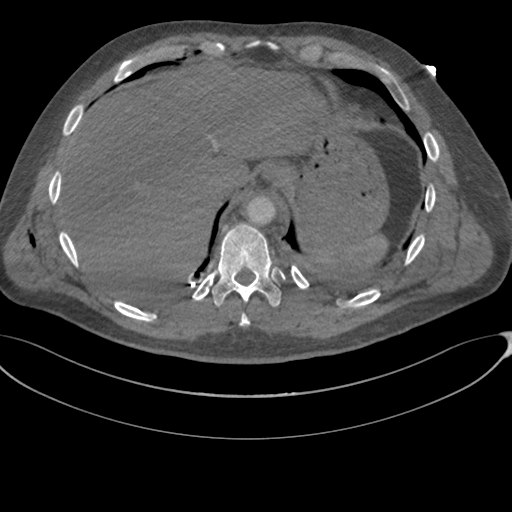 File:Chest multitrauma - aortic injury (Radiopaedia 34708-36147 A 256).png