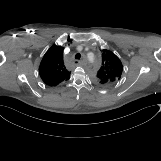 File:Chest multitrauma - aortic injury (Radiopaedia 34708-36147 A 69).png