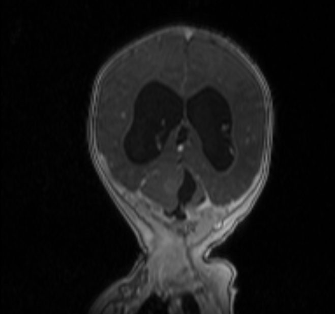 Chiari III malformation with occipital encephalocele (Radiopaedia 79446-92559 Coronal T1 C+ mpr 29).jpg