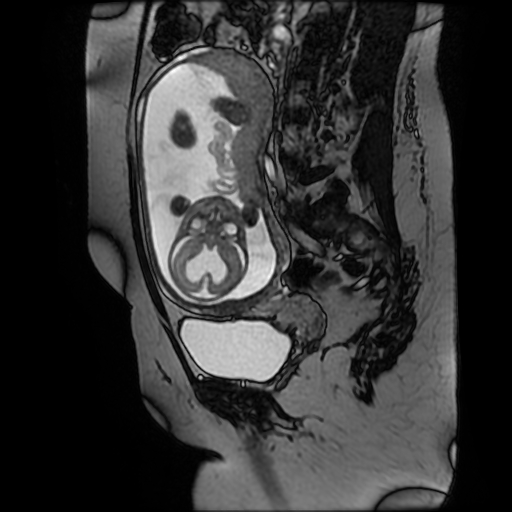 Chiari II malformation - fetal MRI (Radiopaedia 68099-77581 Sagittal Fiesta 24).jpg