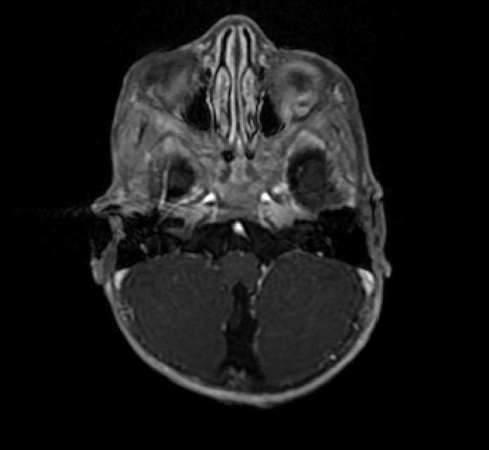 Chiasmatic-hypothalamic glioma (Radiopaedia 90079-107252 Axial T1 C+ 13).jpg