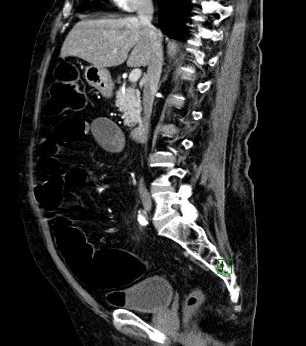Cholangiocarcinoma with cerebral metastases (Radiopaedia 83519-98629 F 69).jpg