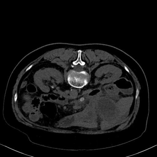 File:Cholecystitis - obstructive choledocholitiasis (CT intravenous cholangiography) (Radiopaedia 43966-47479 Axial 24).png