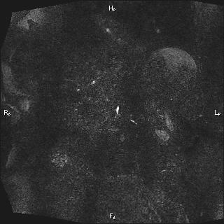 Choledochal cyst - type Ia (Radiopaedia 85673-101454 F 77).jpg