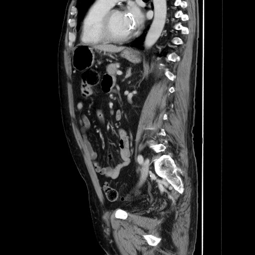 Choledocholiathiasis with normal caliber common bile duct (Radiopaedia 75368-86632 D 99).jpg