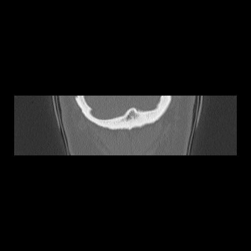 Cholesteatoma (Radiopaedia 84946-100455 Coronal bone window 162).jpg