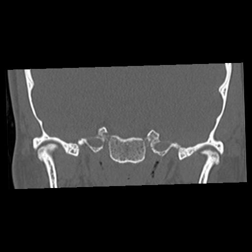 Cholesteatoma (Radiopaedia 84960-100474 Coronal bone window 19).jpg