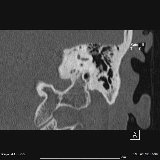 Cholesteatoma - external auditory canal (Radiopaedia 88452-105096 Coronal bone window 41).jpg