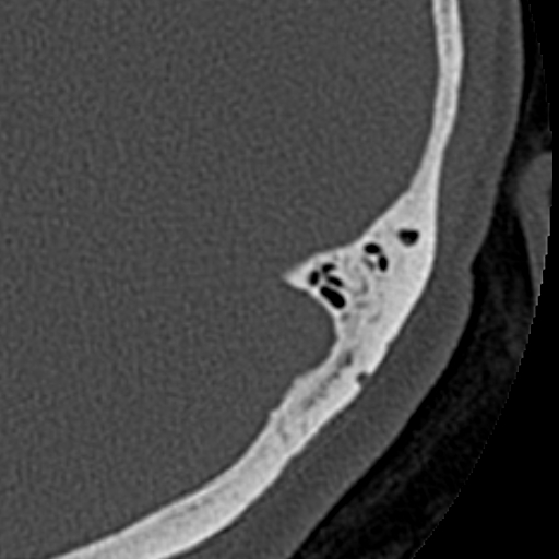 File:Cholesteatoma of the external ear (Radiopaedia 16540-16225 Axial bone window 2).jpg