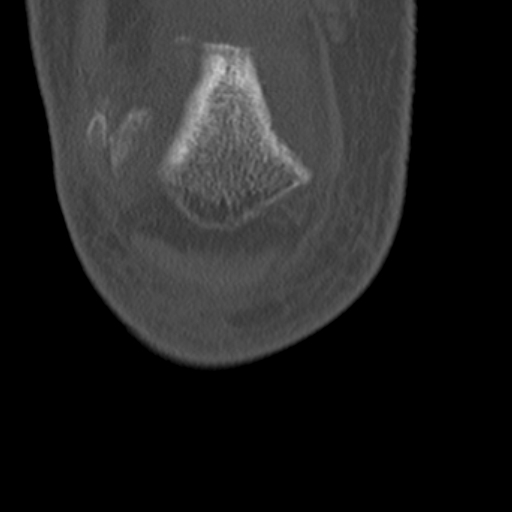 Chondrocalcinosis (Radiopaedia 16275-15955 Coronal bone window 10).jpg