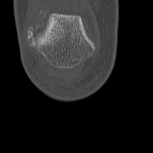Chondrocalcinosis (Radiopaedia 16275-15955 Coronal bone window 8).jpg