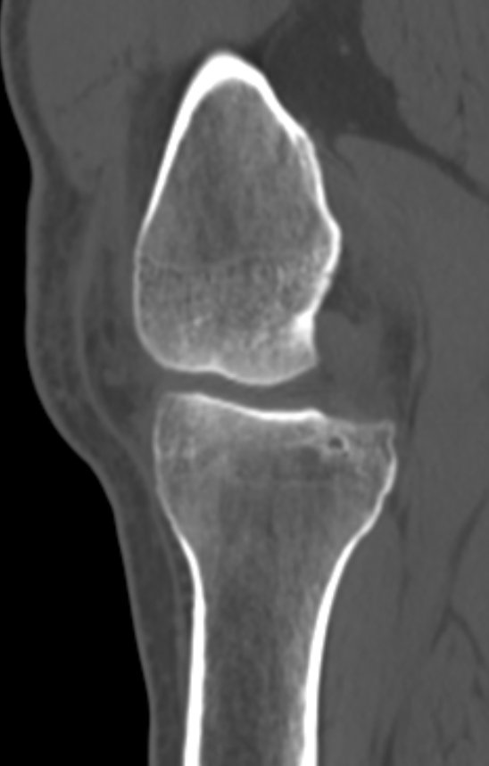 Chondrocalcinosis (Radiopaedia 82862-97173 Sagittal bone window 24).jpg