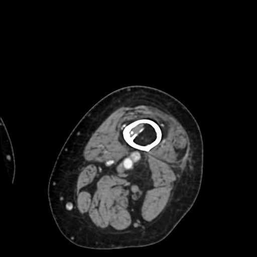 File:Chondrosarcoma - femur (Radiopaedia 64187-72954 Axial with contrast 7).jpg