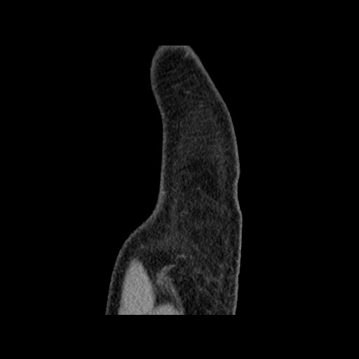 Chondrosarcoma of iliac wing (Radiopaedia 63861-72599 F 11).jpg