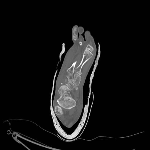 File:Chopart fracture (Radiopaedia 12386-12650 Axial bone window 13).jpg